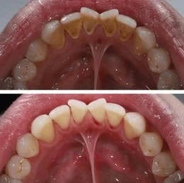 ENJUAGUE DESINTOXICACIÓN BUCAL GURUNANDA + RASPADOR DE LENGUA GRATIS